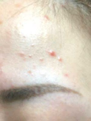 ニキビ跡改善 施術前