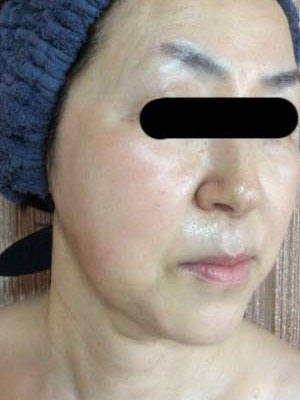 赤ら顔、たるみ改善 施術後