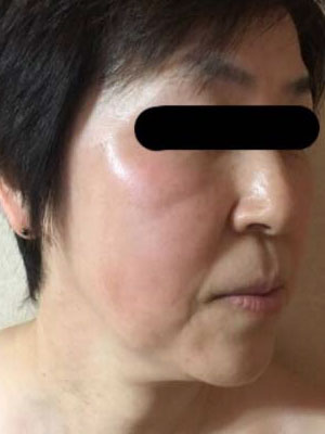 赤ら顔、たるみ改善 施術前