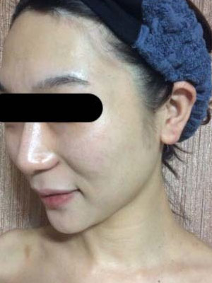 リフトアップ 施術後