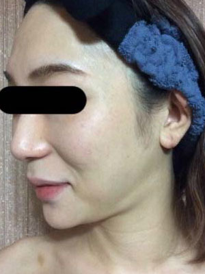 リフトアップ 施術前