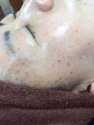 目元のシミ改善 施術後