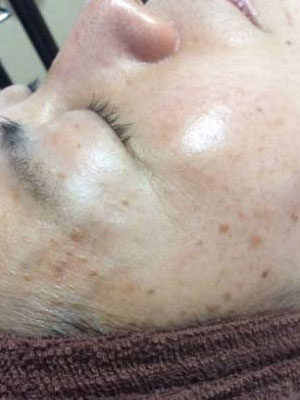 目元のシミ改善 施術前